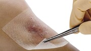 کاهش زمان بهبود زخم‌ها با زخم‌پوش‌های نانو